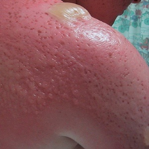 Стафилококковое поражения кожи