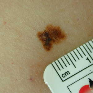 Злокачественная меланома кожи