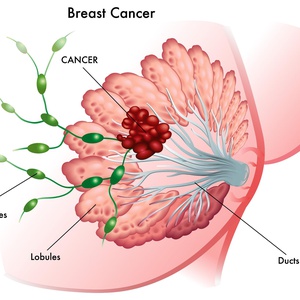Рак груди